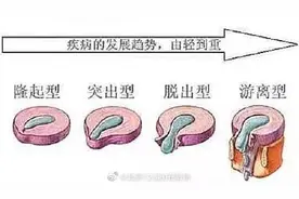 腰椎间盘突出有哪些类型？图片