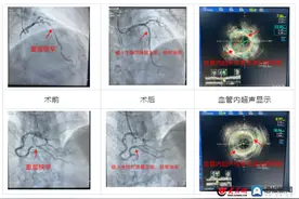 菏泽首例！Xinsorb可降解支架在市级重点学科曹县县立医院心内科顺利开展图片