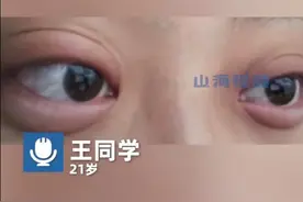 女生分手哭3小时眼睛肿成悲伤蛙，网友：简直就是青蛙本蛙，虽然很同情但真的很像图片