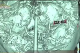 揪心！6岁女孩遭筷子戳眼，直插大脑9cm！事发时家长就在身边……图片