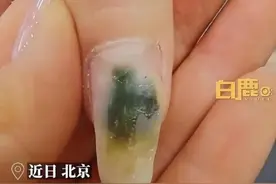 警惕！女子手部指甲发霉变绿，竟是因为这件常做的事情……图片