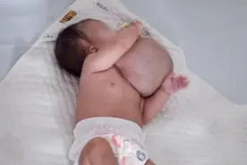 “卸掉”颈部1.3公斤肿物！半岁仔仔首儿所轻装出院图片