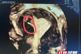 被遗忘的节育环，长到肉里了怎么办？图片