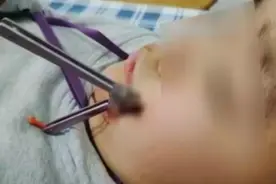 追逐打闹时这种玩具刺入男孩面部……学校附近很多商店有售→图片