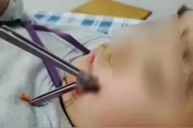 追逐打闹时这种玩具刺入男孩面部……学校附近很多商店有售→图片