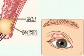 麦粒肿和霰粒肿都是在眼皮上长“痘痘”，家长如何区分呢？图片