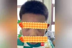 小儿黑眼圈也是因为没睡好？专家提醒家长别忽视图片