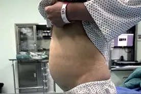 女子长10斤重子宫肌瘤，大腹便便如怀胎十月，医生：该病发病年龄集中在30到50岁图片