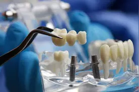 4月20日起，北京种植牙费用将大幅降低图片