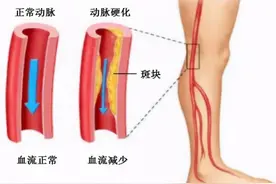 腿走不动路？走一会就腿疼？到底是为什么呢？丨贤医健康说图片