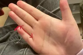 “短指症”上热搜，医生：三种手术可治疗图片