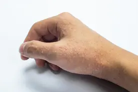 钱报健康小站 | 小水泡反反复复，你可能被汗疱疹盯上了！医生给出四点提醒图片