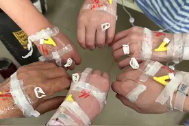 四川一家6口扫墓误认“化儿草”为“血皮菜”食用，集体头晕呕吐图片