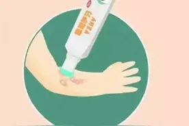 烧伤烫伤后家庭护理应该怎么做？图片