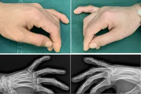 两个小指头末端天生“驼背”状似鹰爪，精巧截骨手术成功矫正图片