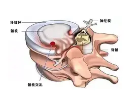 治疗腰椎间盘突出症，光华医院有“妙招”图片