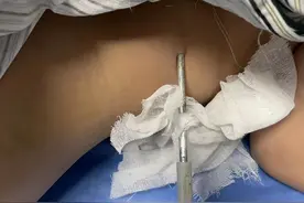 心疼！杭州6岁孩子腰部深深扎入一根地钉，最近出门这事千万当心图片