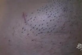 一根“胡子”怎么也刮不掉！杭州小伙患上罕见病，全球仅报道近40例图片