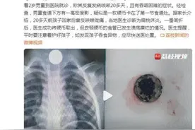 家长警惕！幼童吞下硬币20余天后腐蚀食道图片