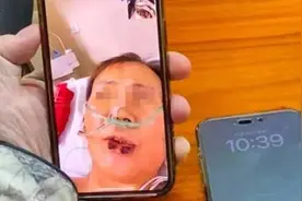 62岁上海阿姨为穿旗袍，抽脂感染住进ICU！6次手术花费上百万，现依然躺在医院图片