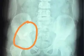 紧急救援！一名8岁男孩误吞长度40mm吸铁石图片