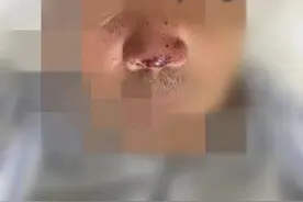 又上热搜！挖鼻孔一时爽，但时不时挖……或有危险图片