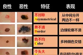 身上这种痣，要不要点？图片