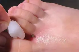 户外踏青注意！12岁女孩脚趾钻进“一条虫”！医生：其可怕之处在于.....图片