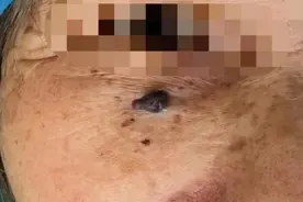 杭州阿姨脸上莫名长痣 医院诊断：并没有这么简单图片