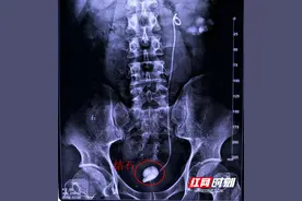 患者结石术后忘取双J管 南湖医院妙手解病痛图片
