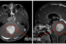 儿医说丨孩子反复头痛、呕吐，注意警惕脑肿瘤图片