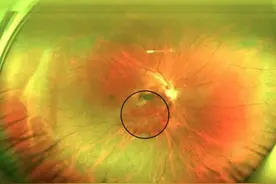 38岁男子看东西模糊，一查竟是白血病！医生紧急提醒！图片