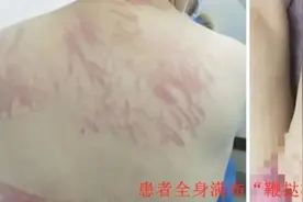 一顿烧烤后，女子全身似遭“鞭打”！ 医生：“香菇皮炎”了解一下图片