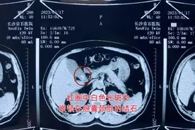 七旬老人突发腹痛晕厥，竟是结石“作祟”图片