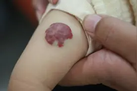 预告｜新生儿血管瘤，观察等待还是就医治疗？图片