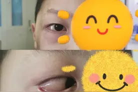 被剥过鸡蛋的手碰了下，6岁男童患上过敏性结膜炎图片