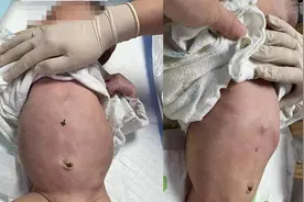 满月宝宝的“大肚子”消失了！首儿所成功救治长段型巨结肠患儿图片