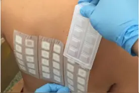 到底啥过敏？斑贴试验帮你找到过敏的元凶图片