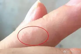 夏天手上老起密密麻麻的水疱，还很痒，是怎么回事？图片