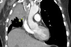 肺癌患者肿瘤压迫上腔静脉，东莞一医院实施手术助其转危为安图片