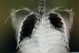 男子在家针灸扎破心脏，自行中医理疗需要注意啥？医生这么说图片