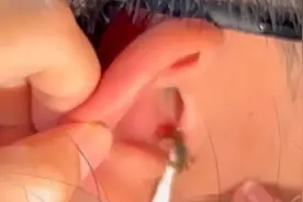 男子浮潜时小螃蟹意外爬进耳洞，上网各种找办法才将螃蟹取出视频封面