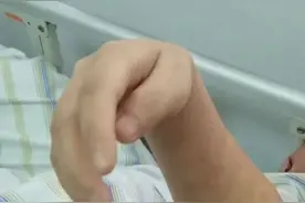 胳膊意外被床板压住4小时，女子桡神经"罢工"数月抬不起手腕图片