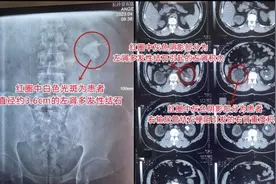男子多次尿血却从未在意，偶然就医检查才知肾脏藏“大家伙”图片