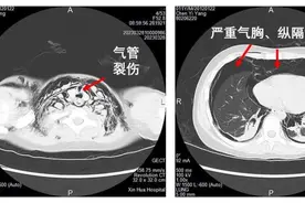 气管破裂，11岁男孩小区骑自行车被狗追赶撞到停放车辆！生死时速上演，连夜跨省转运图片