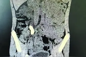 8岁娃腰腹疼痛以为是肠胃炎，一查竟是肾结石！图片