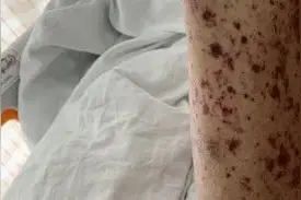 警惕！又到活跃期，一旦感染很可能危及生命图片