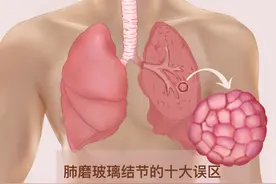 肺磨玻璃结节越来越多！都是肺癌吗？十大误区你中了几个？图片
