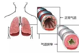 潍坊市中医院应用电子支气管镜氩气刀介入治疗技术联合中医药内服外治成功救治一例肺鳞癌晚期重度气道狭窄患者图片