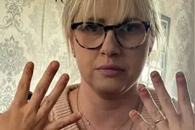 英国一位女子做美甲后发生过敏反应，指甲也开始脱落图片